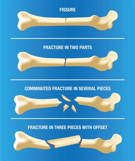 different kinds of fractures