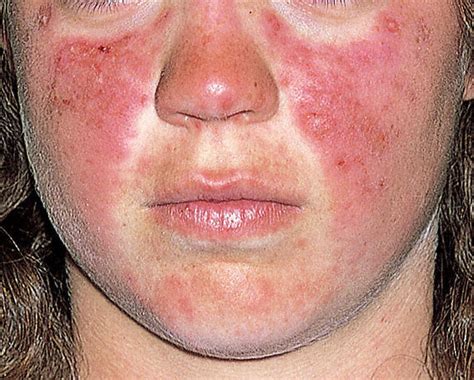 Lupus Rash Pictures Symptoms Causes Treatment Diagnosis