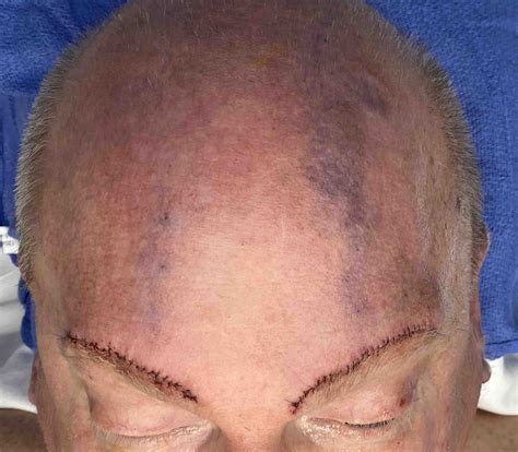 Male Bilateral Forehead Implants Result Intraop Front View Dr Barry