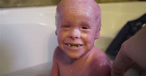 Boy Has Skin That Grows Times Normal Rate Leaving Him With