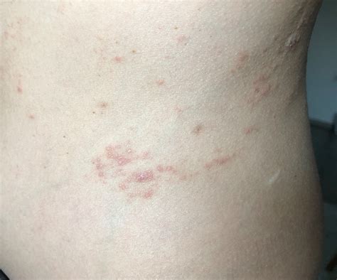 The Eczema First Appeared In June 2019 On The Abdomen Dermatology