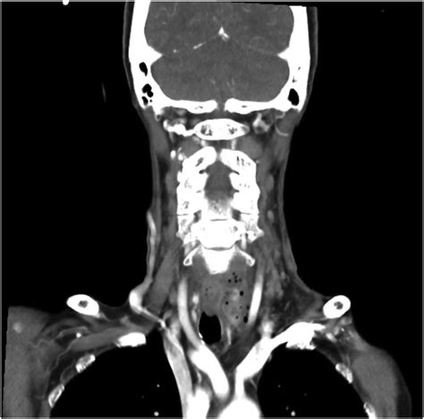 And 4 Coronal And Sagittal View Of Cect Of The Neck Showing A