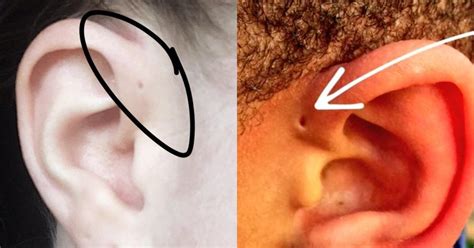 Do You Have A Tiny Hole Above Your Ear There May Be An Evolutionary