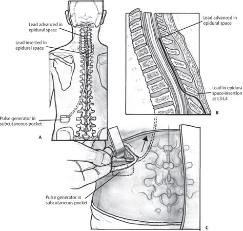 Spinal Cord Stimulation Neupsy Key