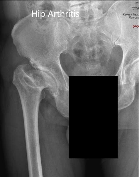 Case Study Coxa Plana Management In A 56 Year Old Male