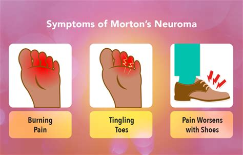 Mortons Neuroma My Doctor Online