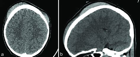 A Axial Noncontrast Ct Head Demonstrating Bilateral Subgaleal Fluid