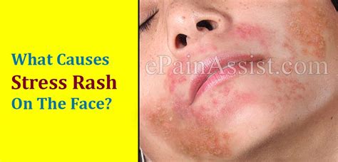 What Causes Stress Rash On The Face And How To Treat It