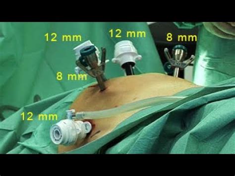 Robot Assisted Radical Prostatectomy Robot Assisted Surgical Removal Of The Prostate Youtube