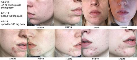 Tips For Easing The Irritation Of Tretinoin | Heidi Salon