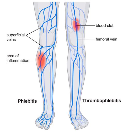 Phlebitis And Blood Clots Preferred Vascular Group
