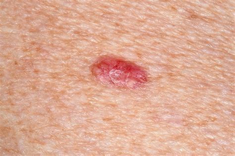 Basal Cell Carcinoma Skin Cancer Stock Image C0370918 Science