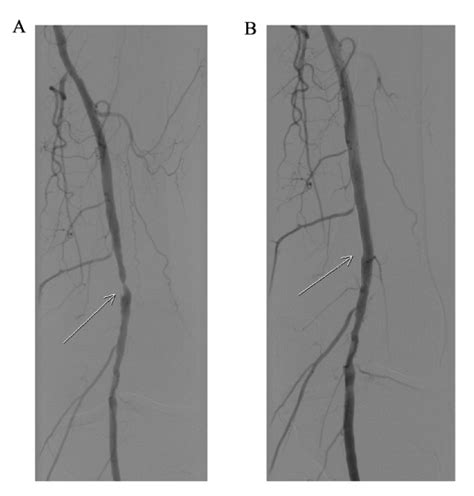 Peripheral Angioplasty Of The Lower Limb Arteries Centre De