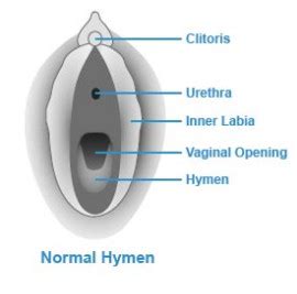 Hymen Location Pictures Surgery And Repair