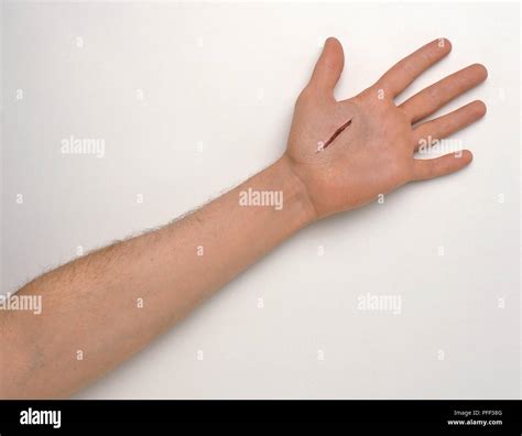 Deep Cut On Palm Of Hand Stock Photo Alamy