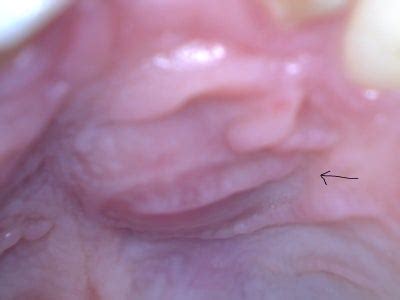 Bumps that develop on the roof of the mouth are symptoms of several disease conditions. Bump on Roof of Mouth For 1 Year? (photo) Doctor Answers, Tips
