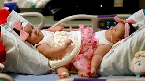 Rare Conjoined Twin Sisters Born In A Set Of Triplets Are Successfully Separated After Mammoth