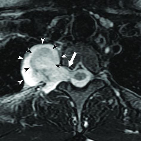 A 44 Year Old Man With A Neurofibroma In The Right Paravertebral