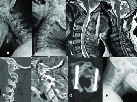 Radiographs Showing Occipitocervical Instability Oci Attributed To