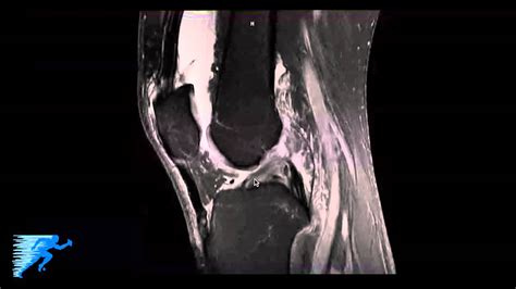 How To Read Knee Mri Of Lcl Tear Complex Knee Surgeon