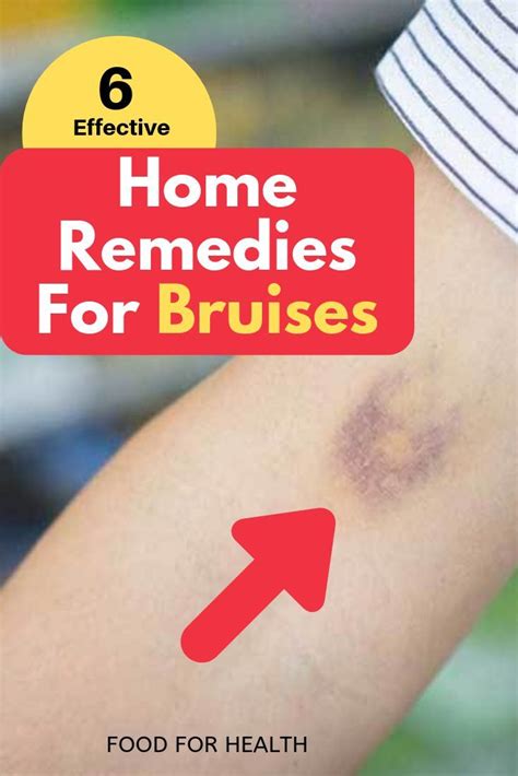 6 Effective Home Remedies For Bruises Home Remedies For Bruises