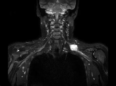 Brachial Plexus Lesion Philips Mr Body Map