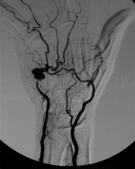 Reconstruction For Ulnar Artery Aneurysm At The Wrist Journal Of Hand