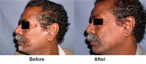 Multiple Dermatofibromas On Face Treated With Carbon Dioxide Laser Indian Journal Of