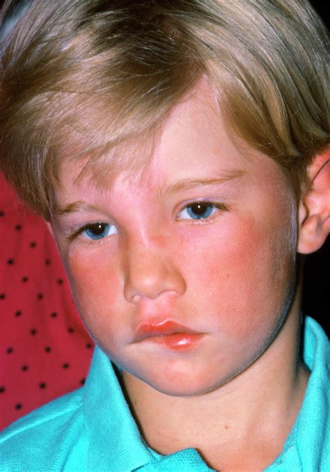 Child Affected By Allergic Urticaria On His Face Photograph By Dr P