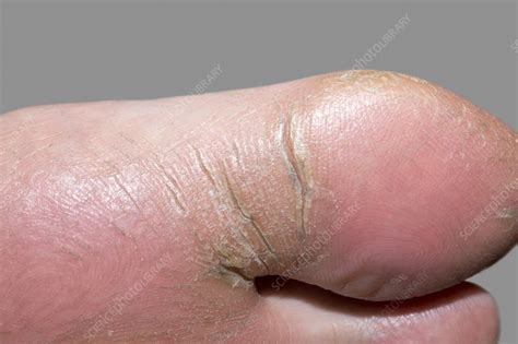 Eczema Of The Foot Stock Image C0194110 Science Photo Library
