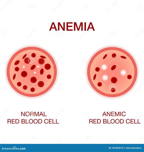 Anemia Blood Cells