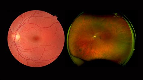 Sattel Anwendbar Geben Scanning Laser Ophthalmoskopie Diskutieren