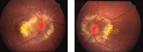 Fundus Photos Demonstrates Bilateral Optic Disc Edema And Extensive