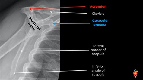 Shoulder Anatomy X Ray Labeled