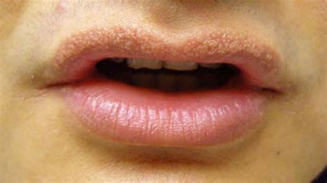 Sweat Gland Cyst In Lip