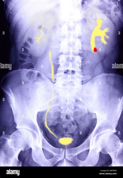 Kidney Stone X Ray Stock Photo Alamy