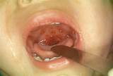 Angina Throat Treatment Images