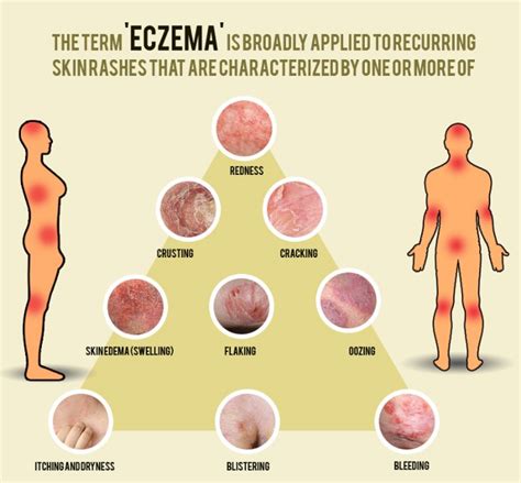 Pin On Brief Guidance On Different Types Of Eczematous Dermatitis