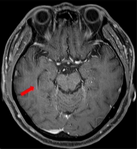 T1 Weighted Contrast Enhanced Magnetic Resonance Imaging Mri Of The