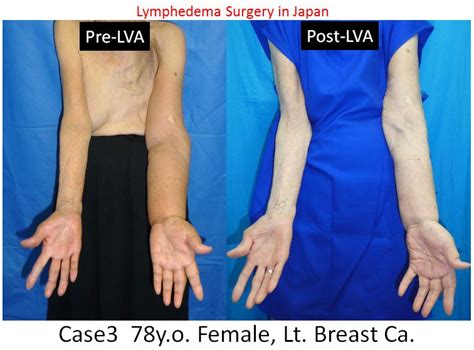 Lymphedema Surgery Japan Dr Mihara Male ＆ Dr Hara Female