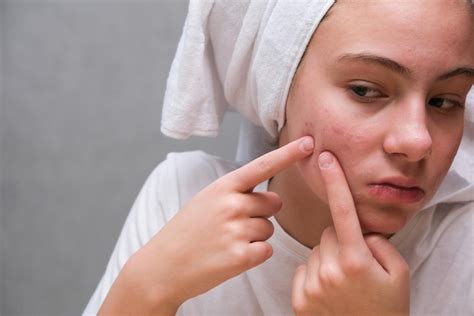 Premium Photo Acne A Teenage Girlsqueezing Out A Pimple Pimples On