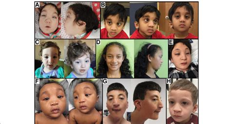 Craniofacial And Dysmorphology Features In Individuals With Pathogenic Download Scientific