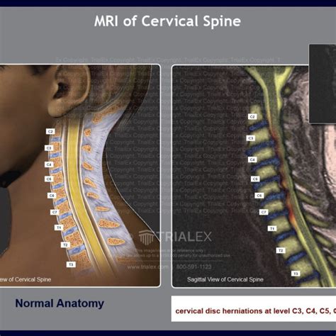 Mri Of Cervical Spine Trialexhibits Inc Free Nude Porn Photos