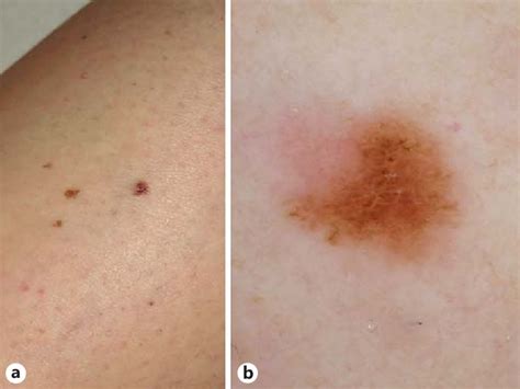 The Excision Of This Clinically Inconspicuous Melanoma On The Leg Of A
