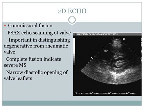 PPT - ECHOCARDIOGRAPHY IN MITRAL STENOSIS PowerPoint Presentation, free