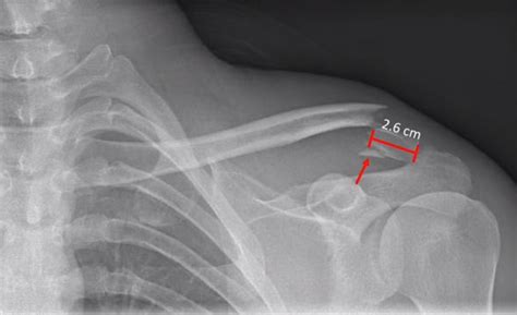 Distal Clavicle Fracture Orif With Hook Plate —