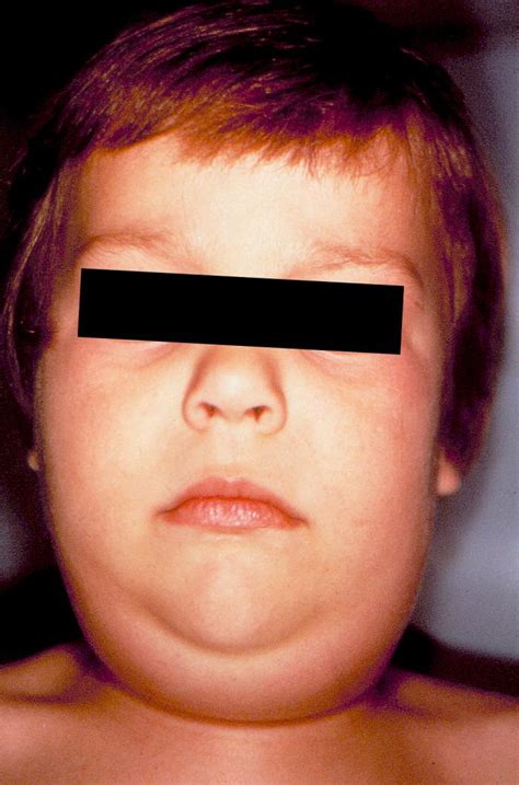 Parotid Gland Swelling Children