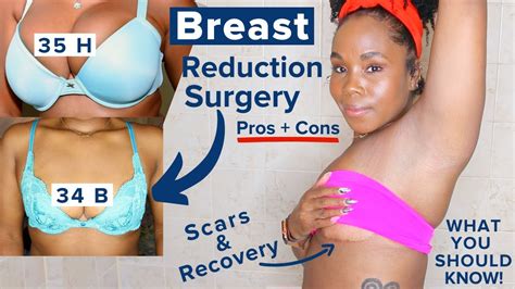 My Breast Reduction Breast Lift Recovery Story Scars Dark Marks