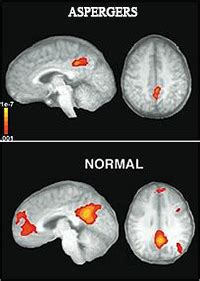 Children with asperger's syndrome show patterns of brain connectivity distinct from those of children with we looked at a group of 26 children with asperger's, to see whether measures of brain. Neuroscience Sheds Light on Why People with Asperger's Syndrome Lack Empathy