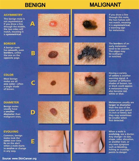 The Abcde Rule Of Skin Cancer Quality Dermatology